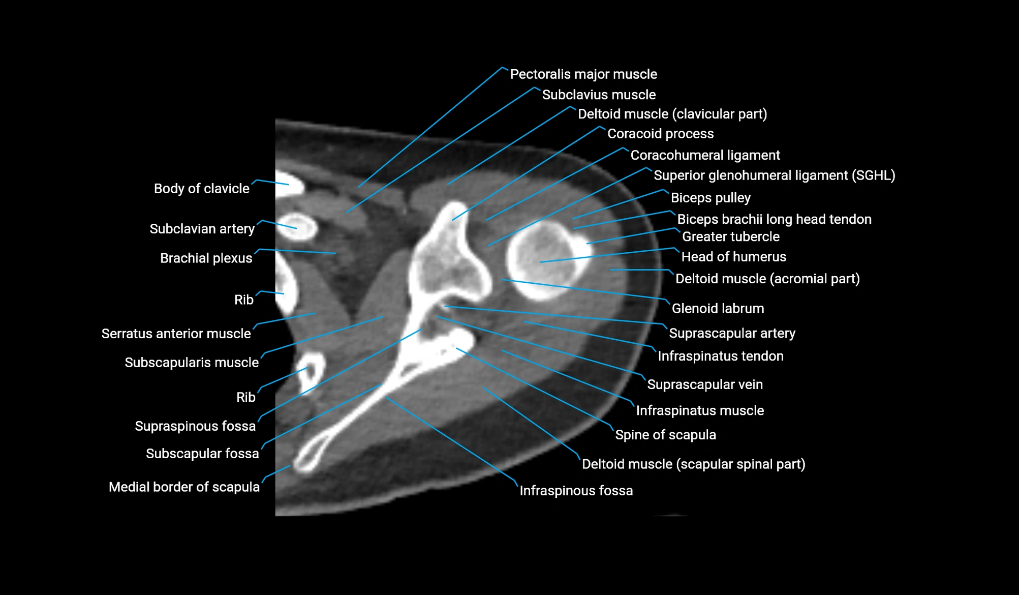 CT upper arm axial  cross sectional anatomy labelled radiology image -00080.webp